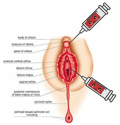 Vaginal Rejuvenation Technique process