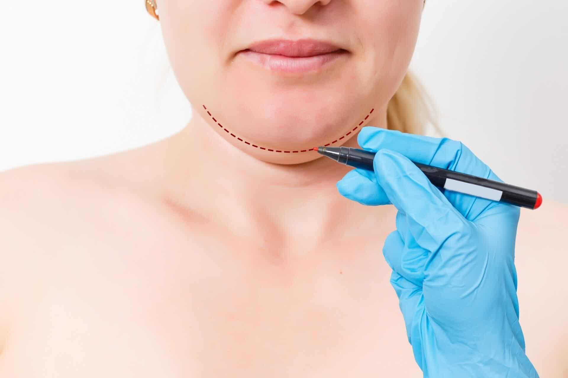 Double Chin marking for the treatment