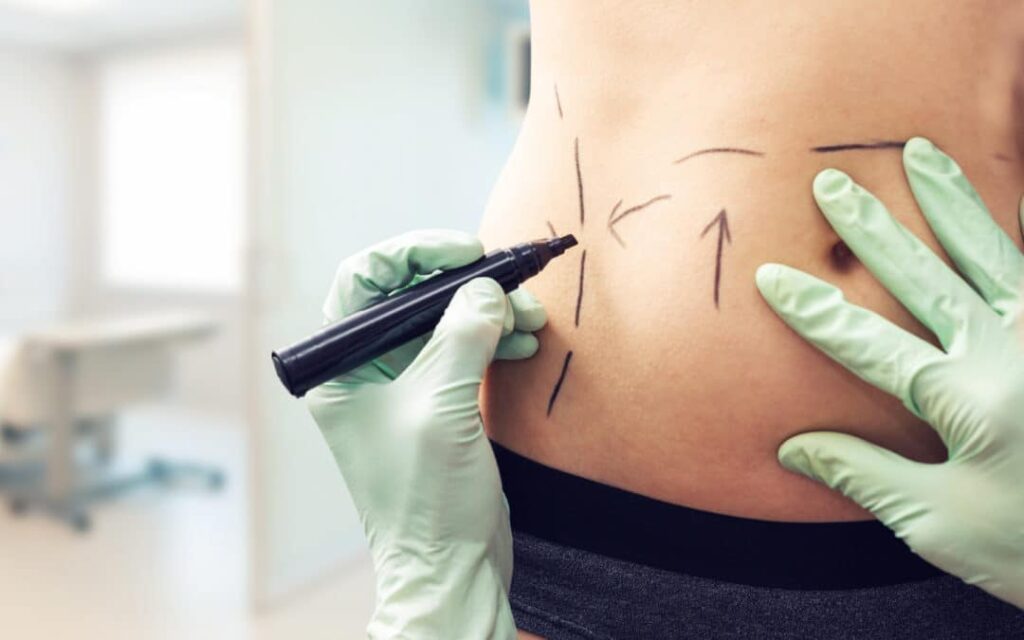 Know The Steps For Smart Liposuction