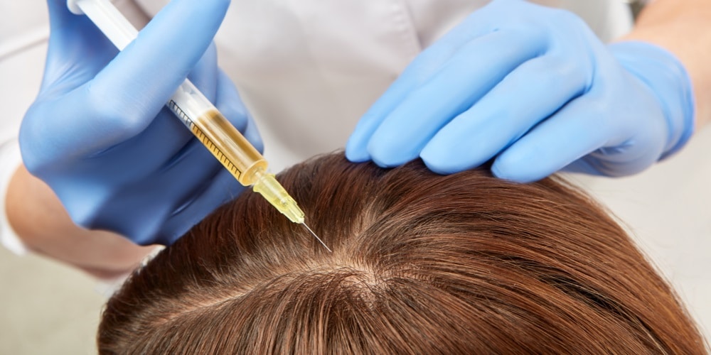 PRP Hair Restoration in Houston - ShineMD Medspa & Liposuction Center