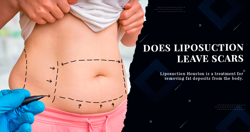 Does-Liposuction-Leave-Scars
