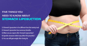 Five-Things-You-Need-to-Know-About-Stomach-Liposuction