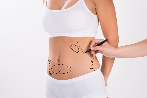 More About Liposuction