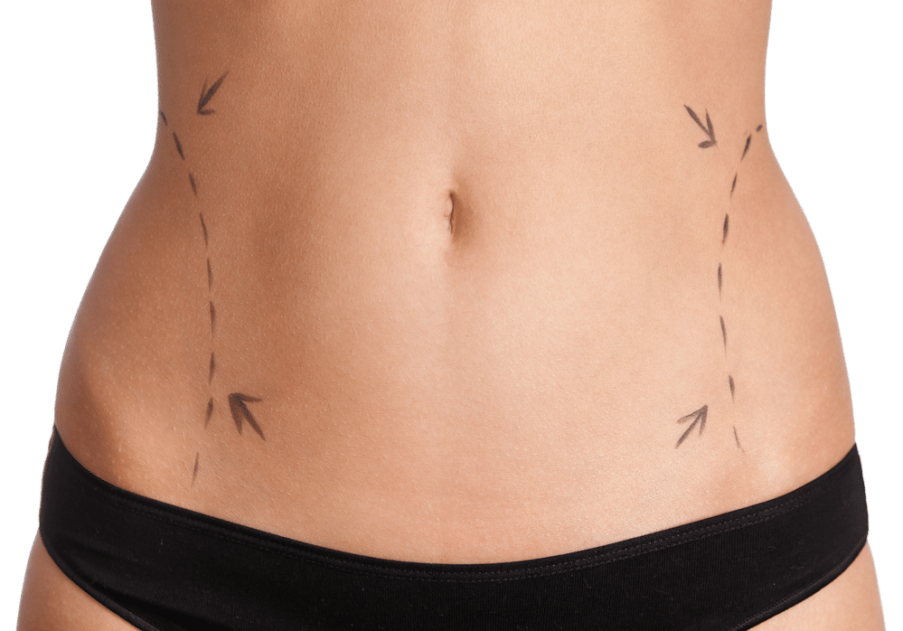Stomach Liposuction