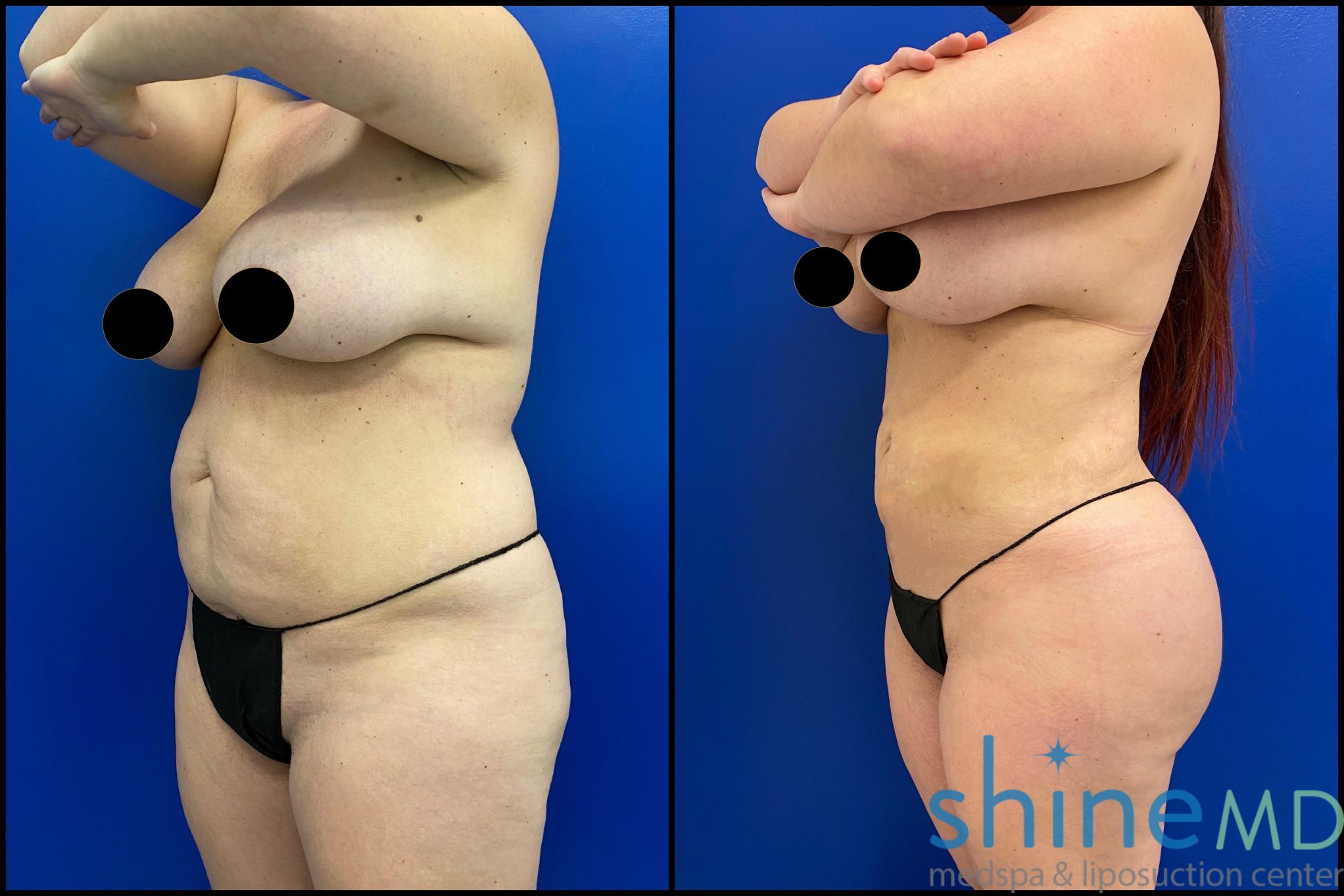 FRONT VIEW of smart lipo treatment