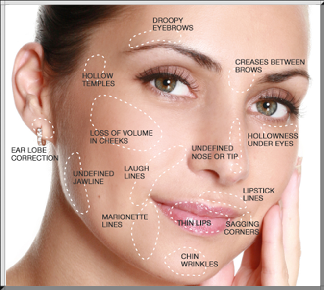 Which Areas Are Treated With Dermal Fillers