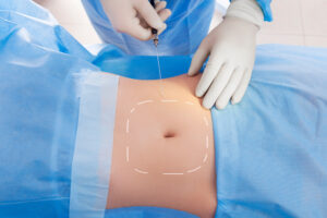 Smartlipo® / Laser Assisted Liposuction