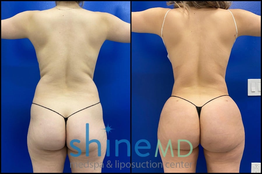 Lipo 360 with BBL before and after  back view patient 1533385