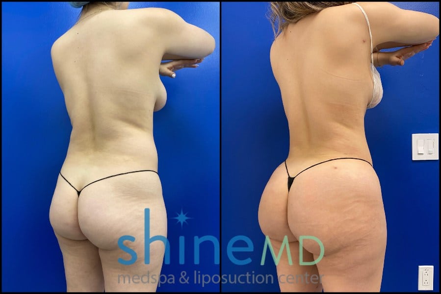 Lipo 360 with BBL before and after  back oblique view patient 1533385