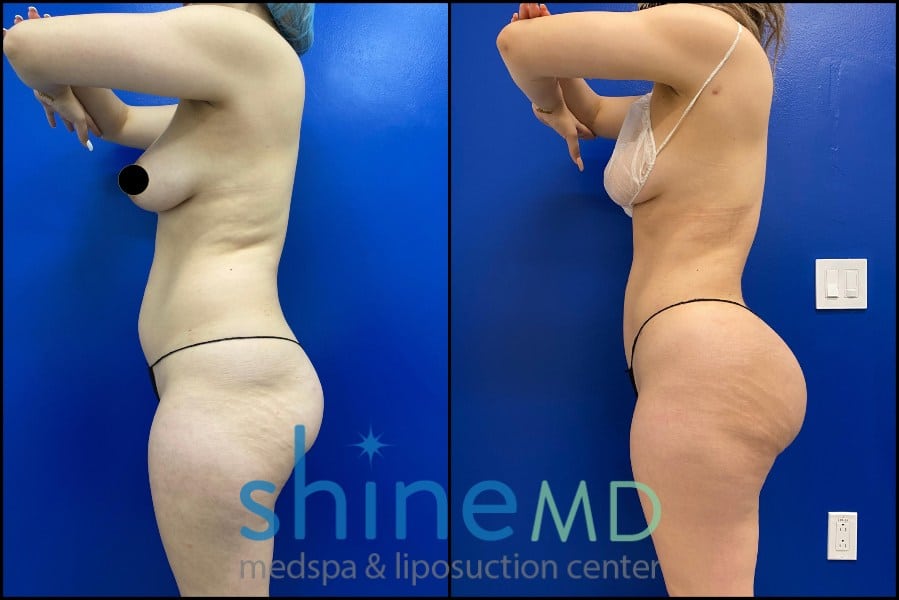 Lipo 360 with BBL before and after  side view patient 1533385