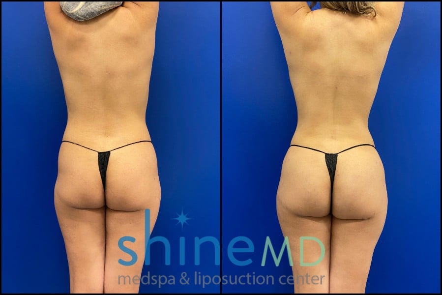 lipo 360 with fat transfer to buttocks back view patient 1547695
