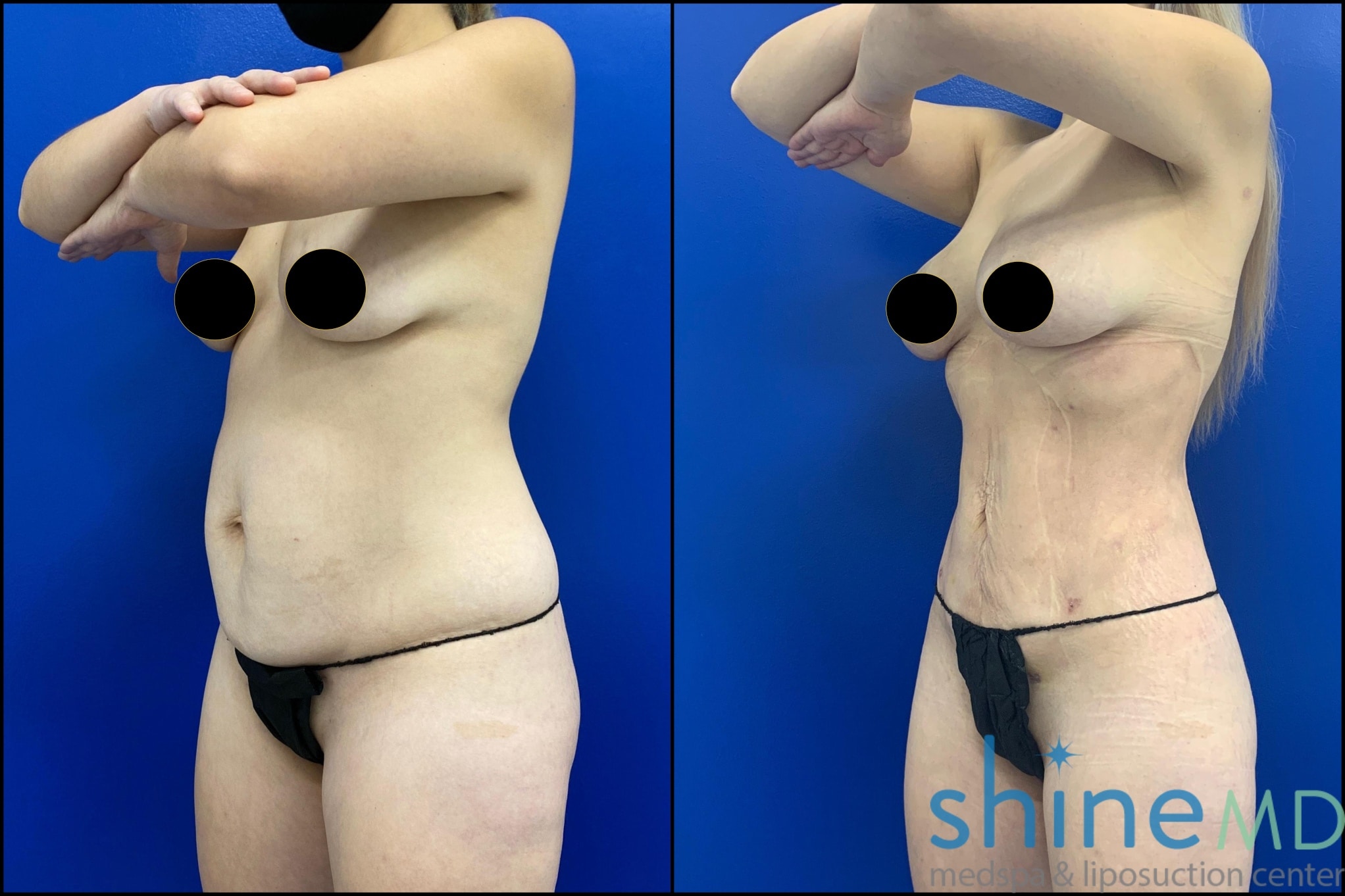 OBLIQUE VIEW of breast augmentation before and after photo