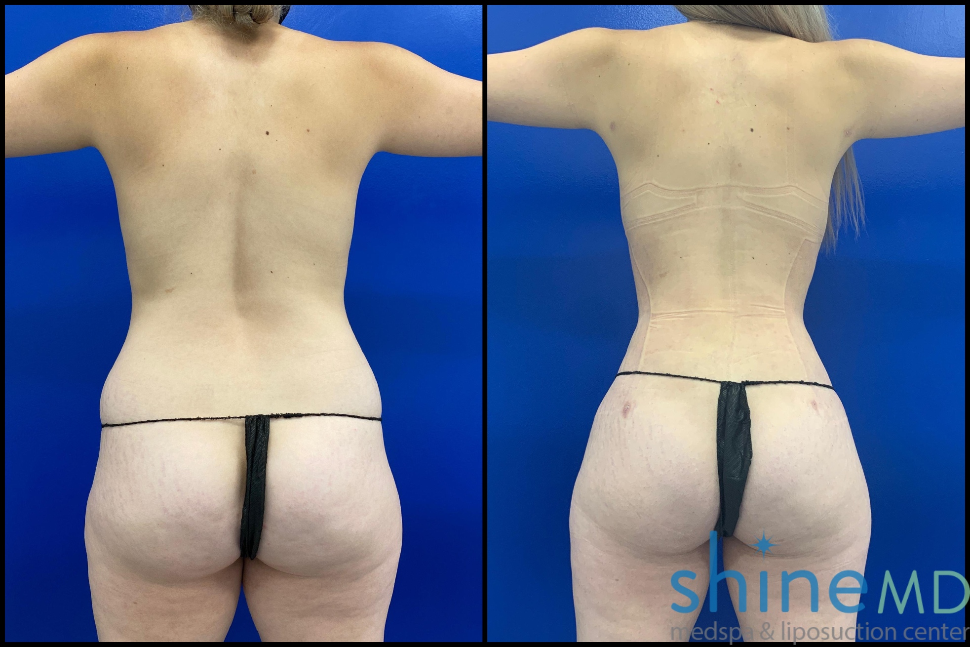 BACK VIEW of breast augmentation before and after photo