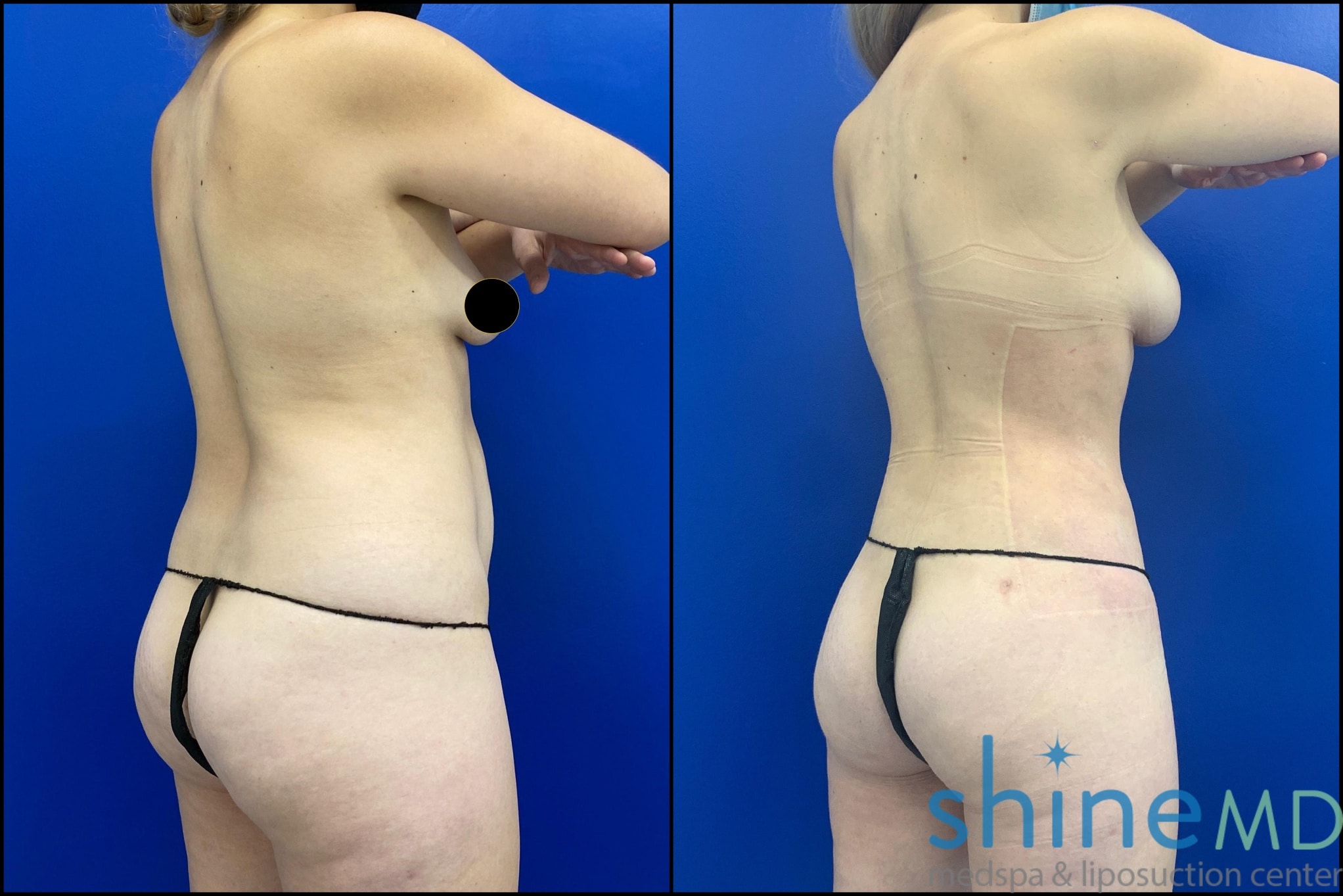 BACK OBLIQUE VIEW of breast augmentation before and after photo