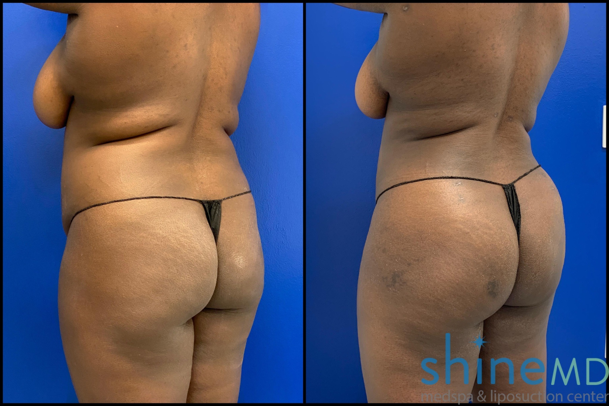 Liposuction 360 before and after image
