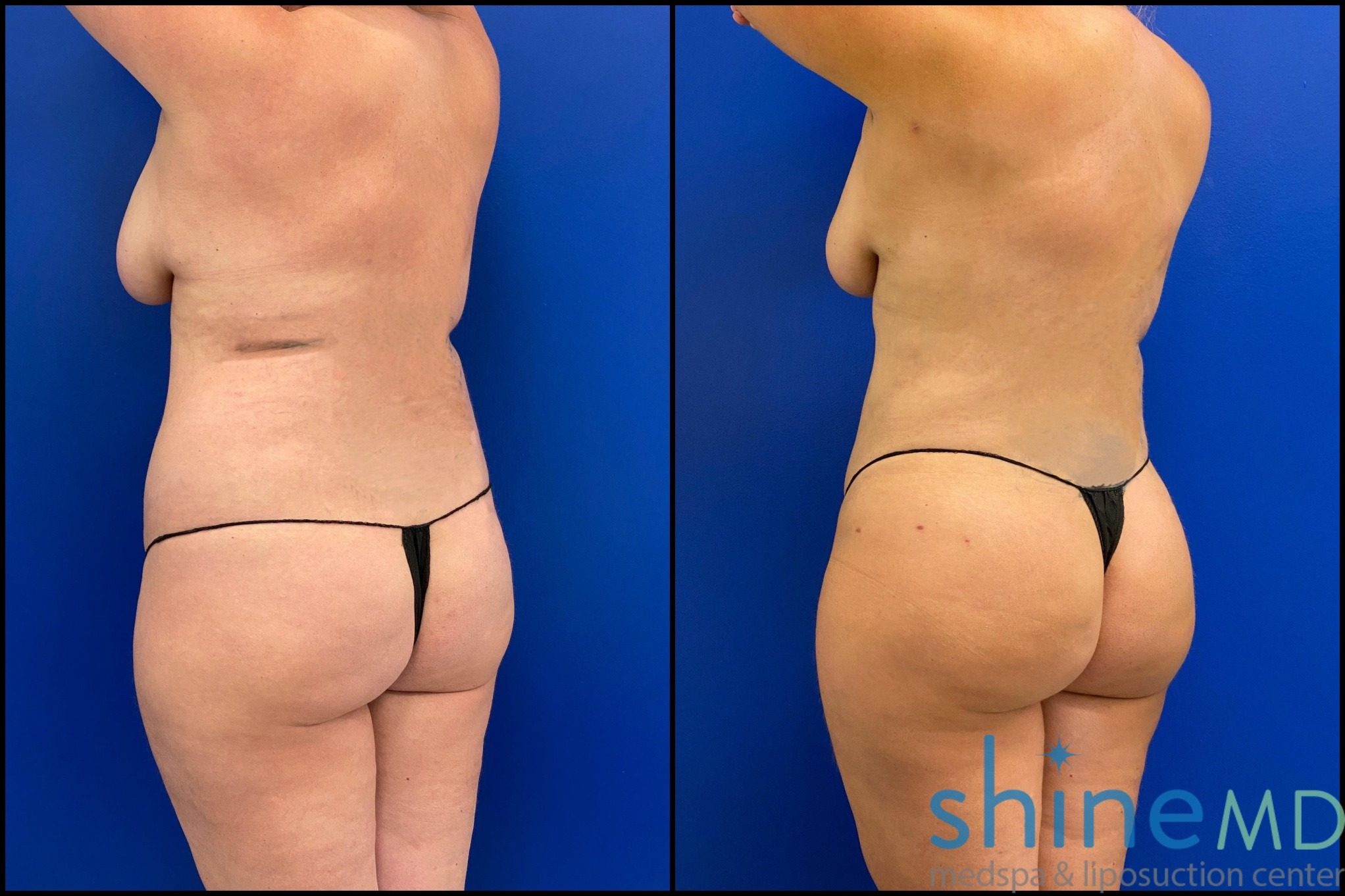 Brazilian butt lift before and after pictures