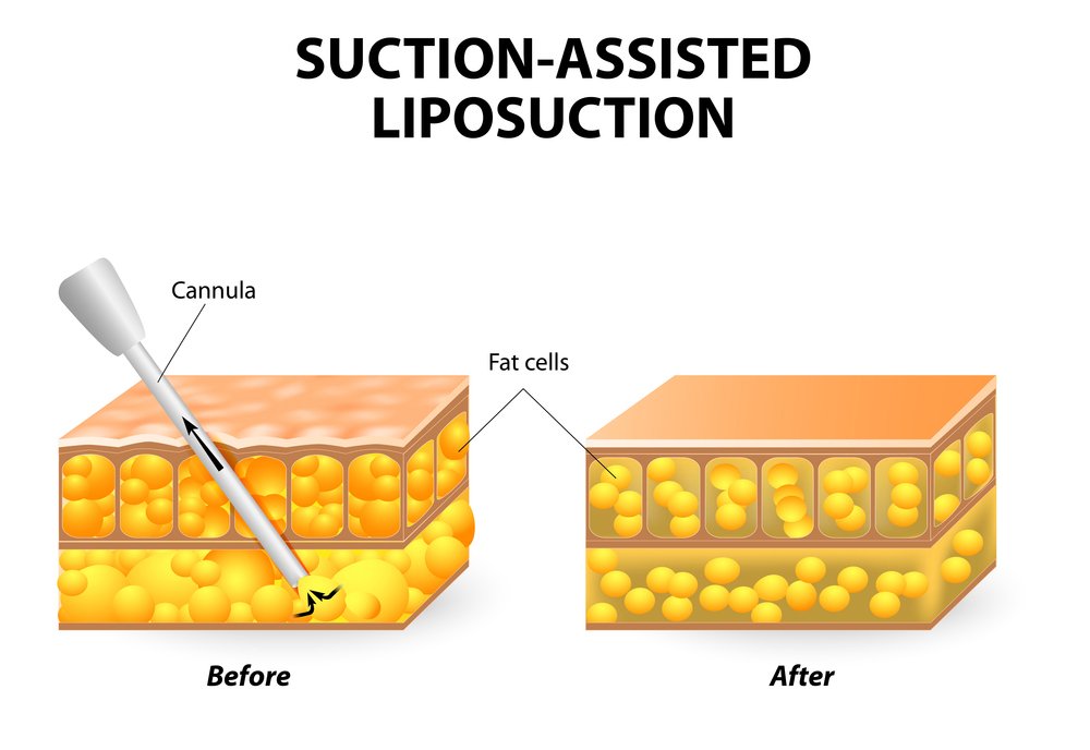 Traditional-Suction-Assisted-Liposuction-in-korea-1
