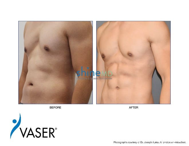 vaser liposuction with abs etching in male 2
