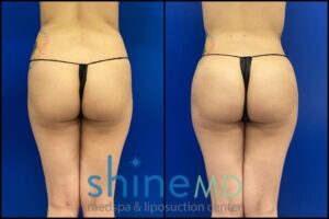 Brazilian Butt Lift before and after photo Results