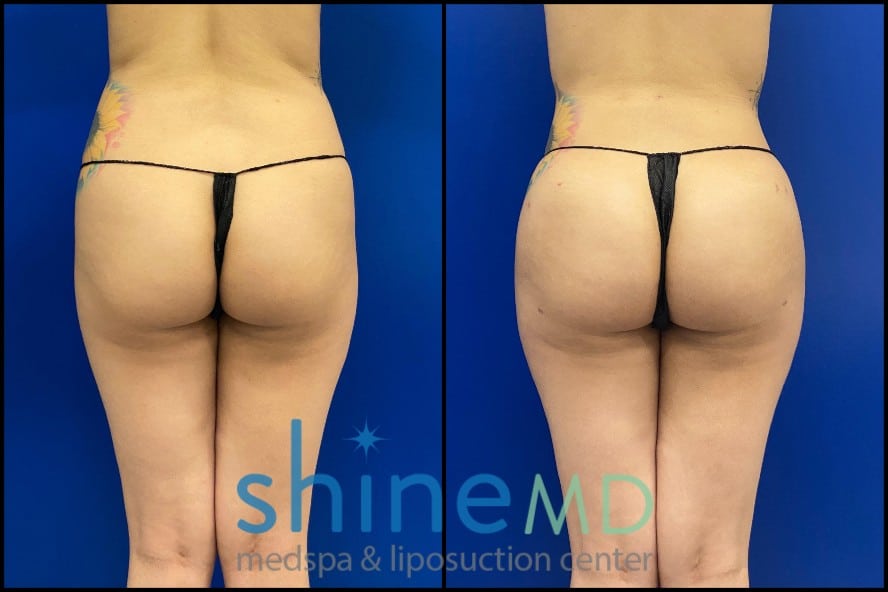 Brazilian Butt Lift before and after photo Results patient 2007