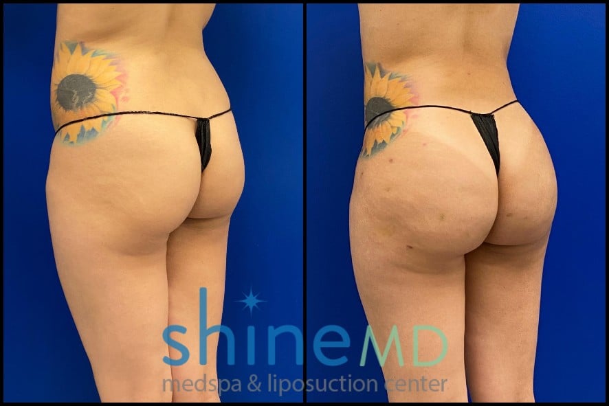 Brazilian Butt Lift before and after photo Results patient 2007 back oblique