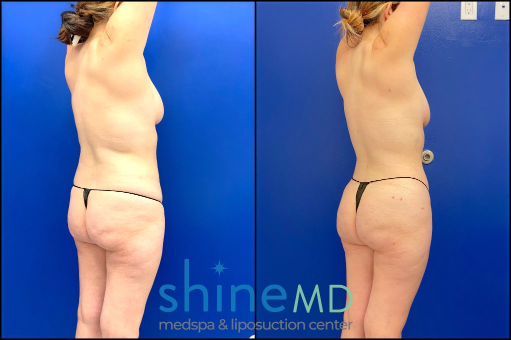 lipo 360 with bbl before and after picture patient 02010 back oblique