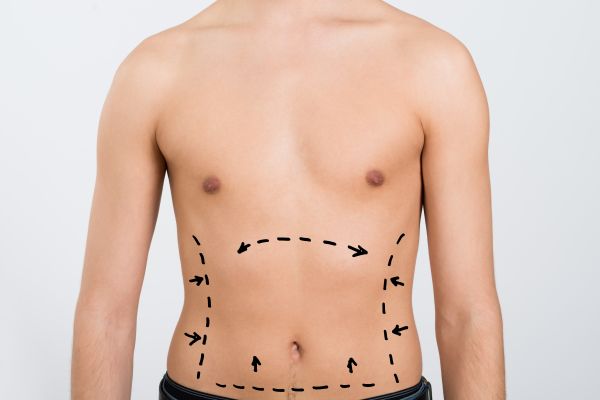 What Is Male Liposuction