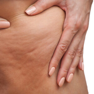 Z‑Wave Cellulite Treatment