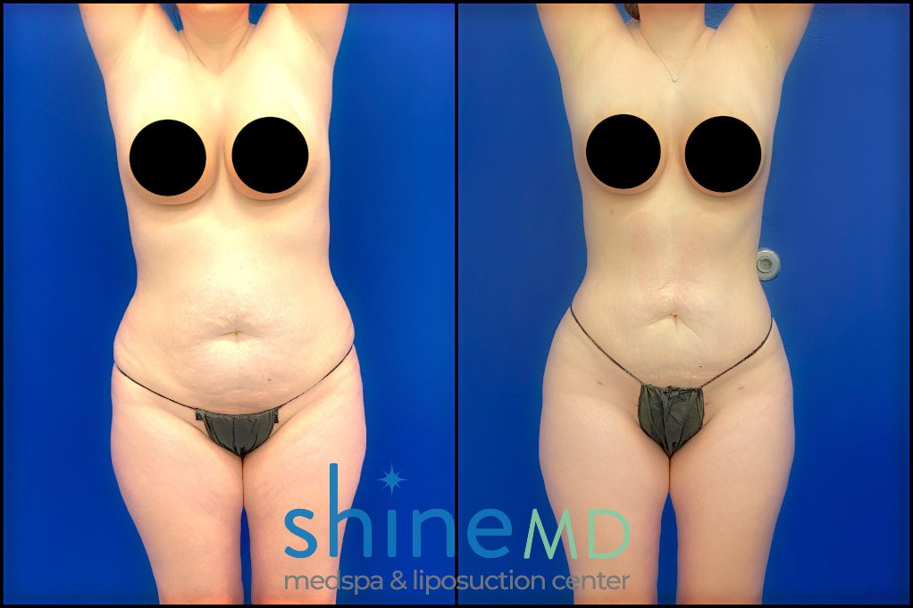 lipo 360 with bbl before and after picture patient 02010 front