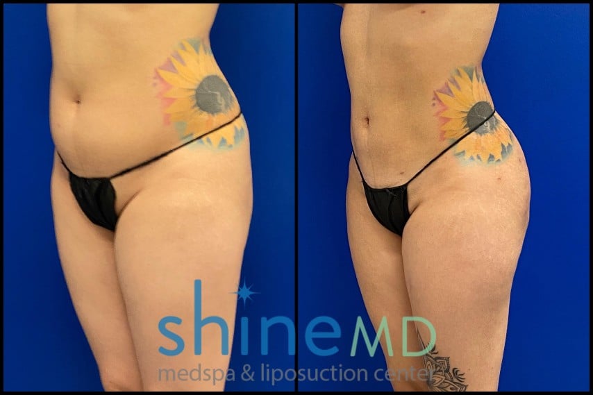 Brazilian Butt Lift before and after photo Results patient 2007 front oblique