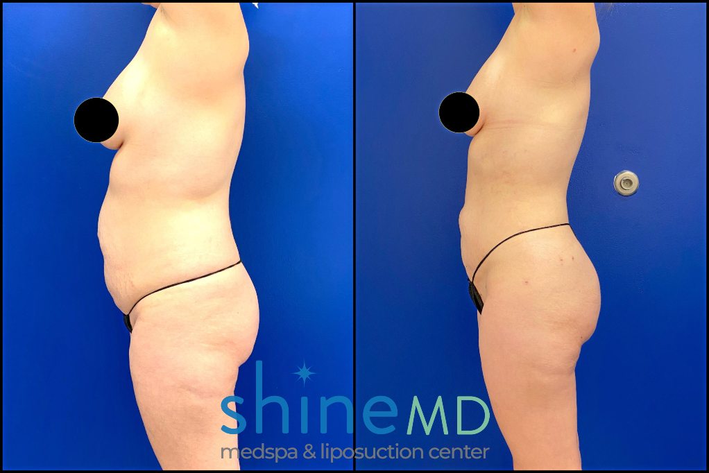 Brazilian Butt Lift before and after photo Results patient 2007 side view