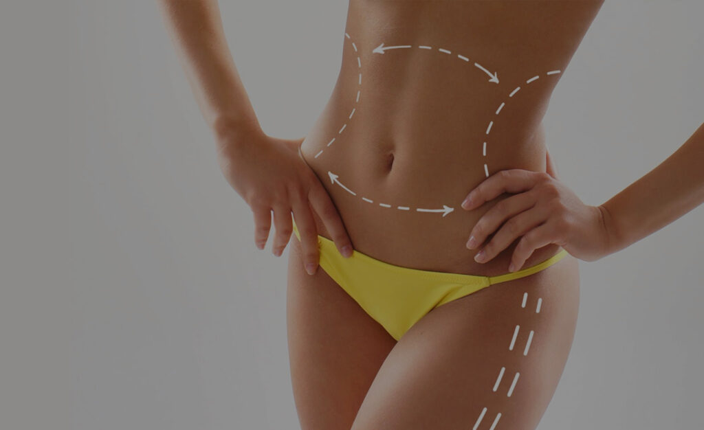 HiDef Vaser Liposuction with abs etching