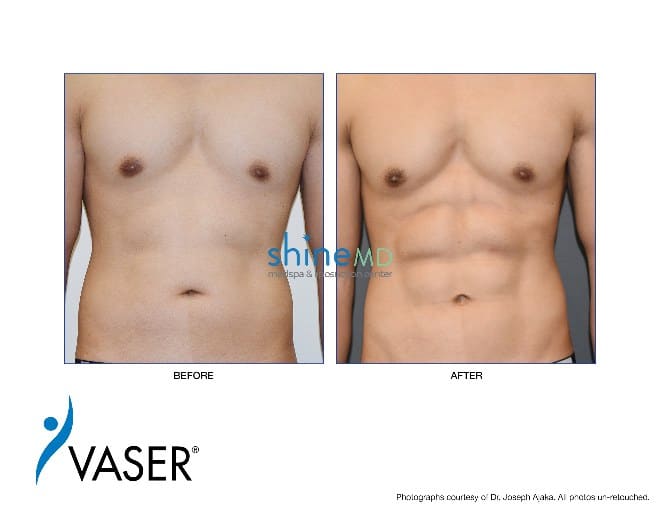 HIGH DEF Liposuction with abs etching
