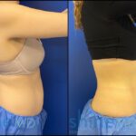 CoolSculpting Center in Houston