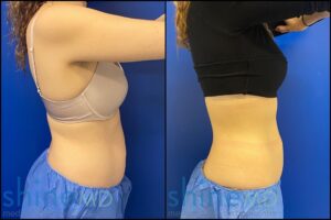 CoolSculpting Center in Houston