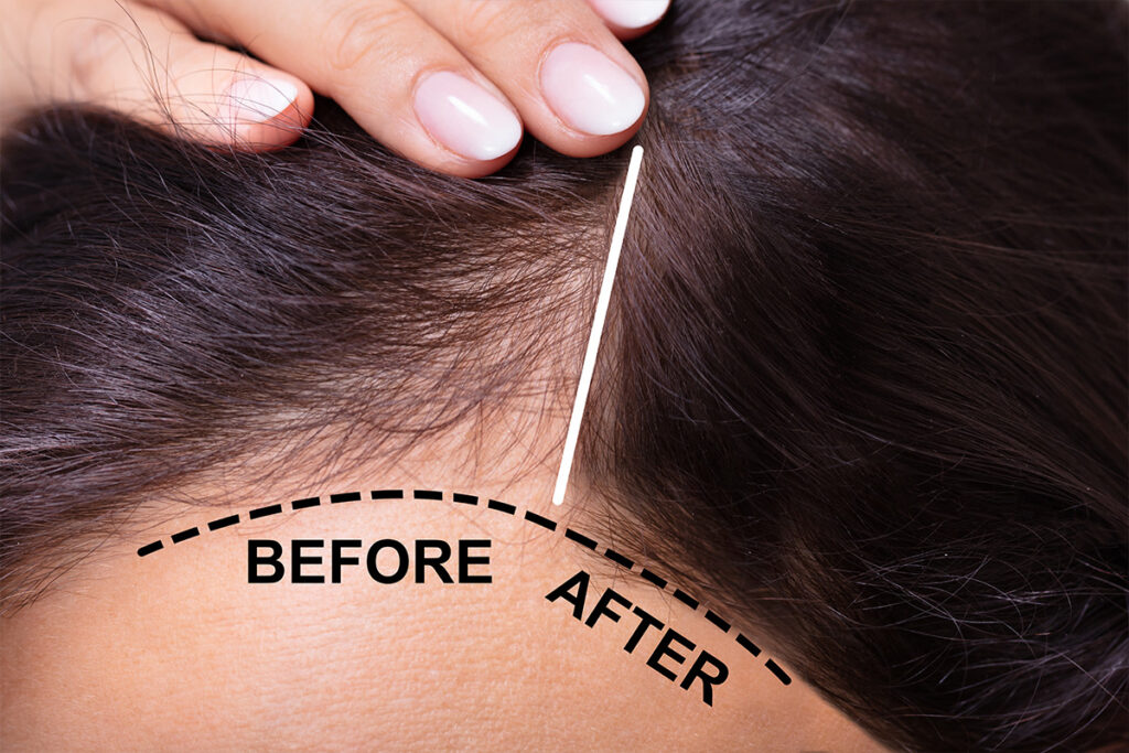Benefits Of PRP Hair Restoration