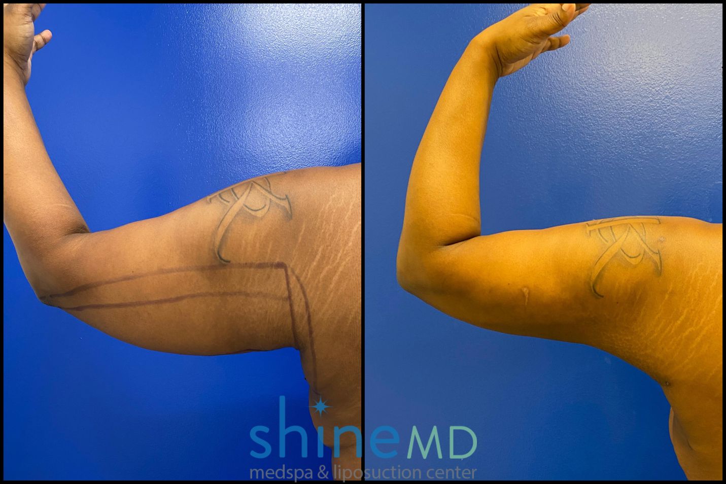 before and after photos of arm liposuction treatment