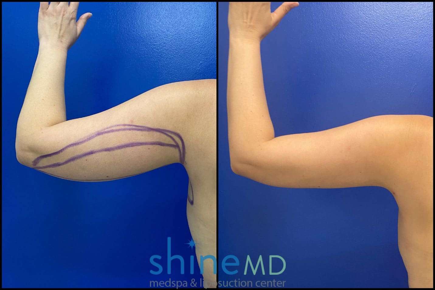 Liposuction arm Lipo patient before and after photos
