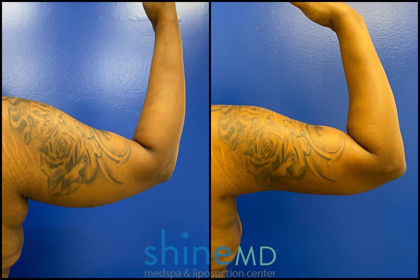 arm liposuction treatment photos