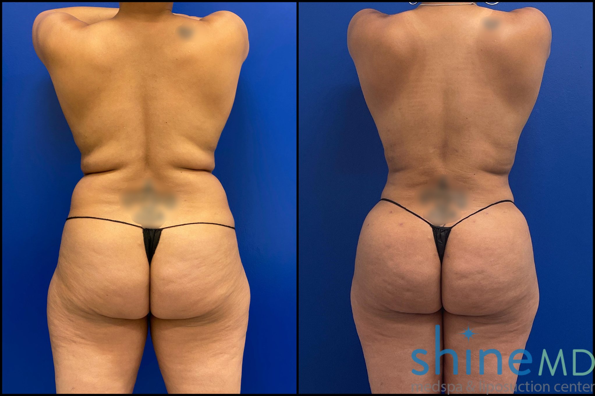 liposuction surgery before and after photos