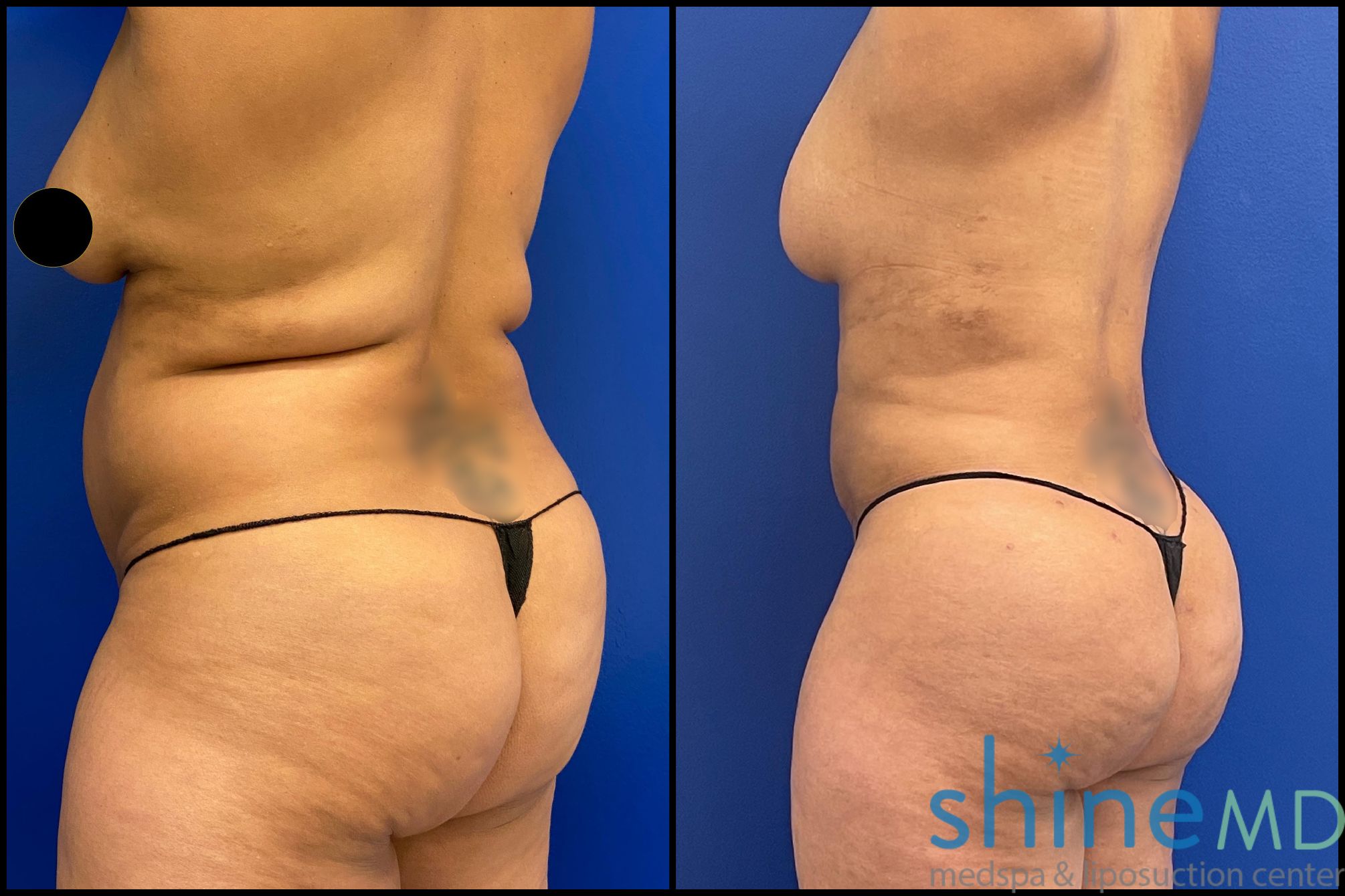 liposuction surgery photos