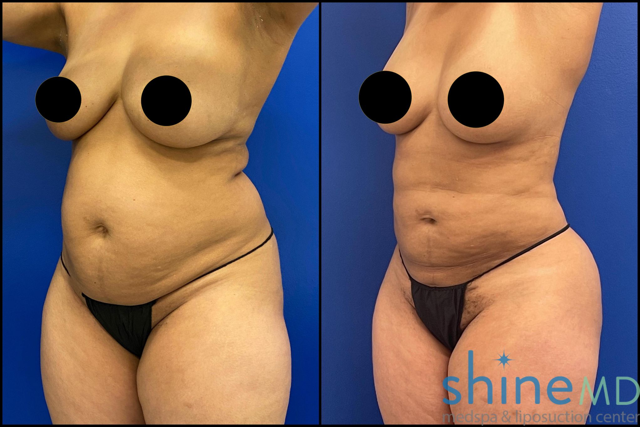 lipo treatment before and after photos