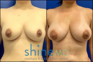 Breast augmentation with fat transfer patient 002046