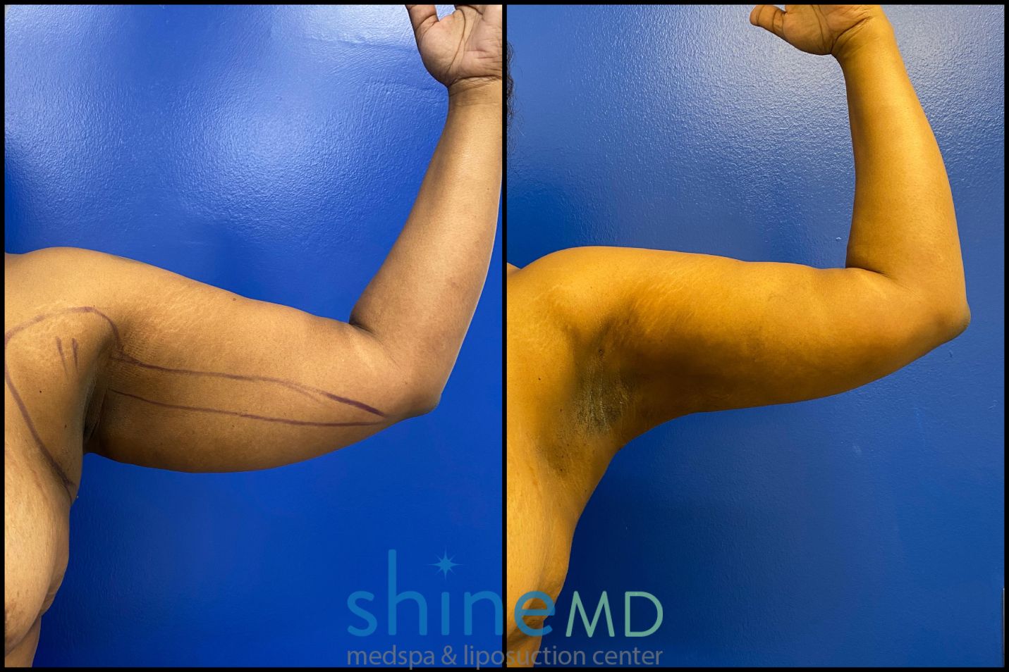 arm liposuction treatment before and after photos