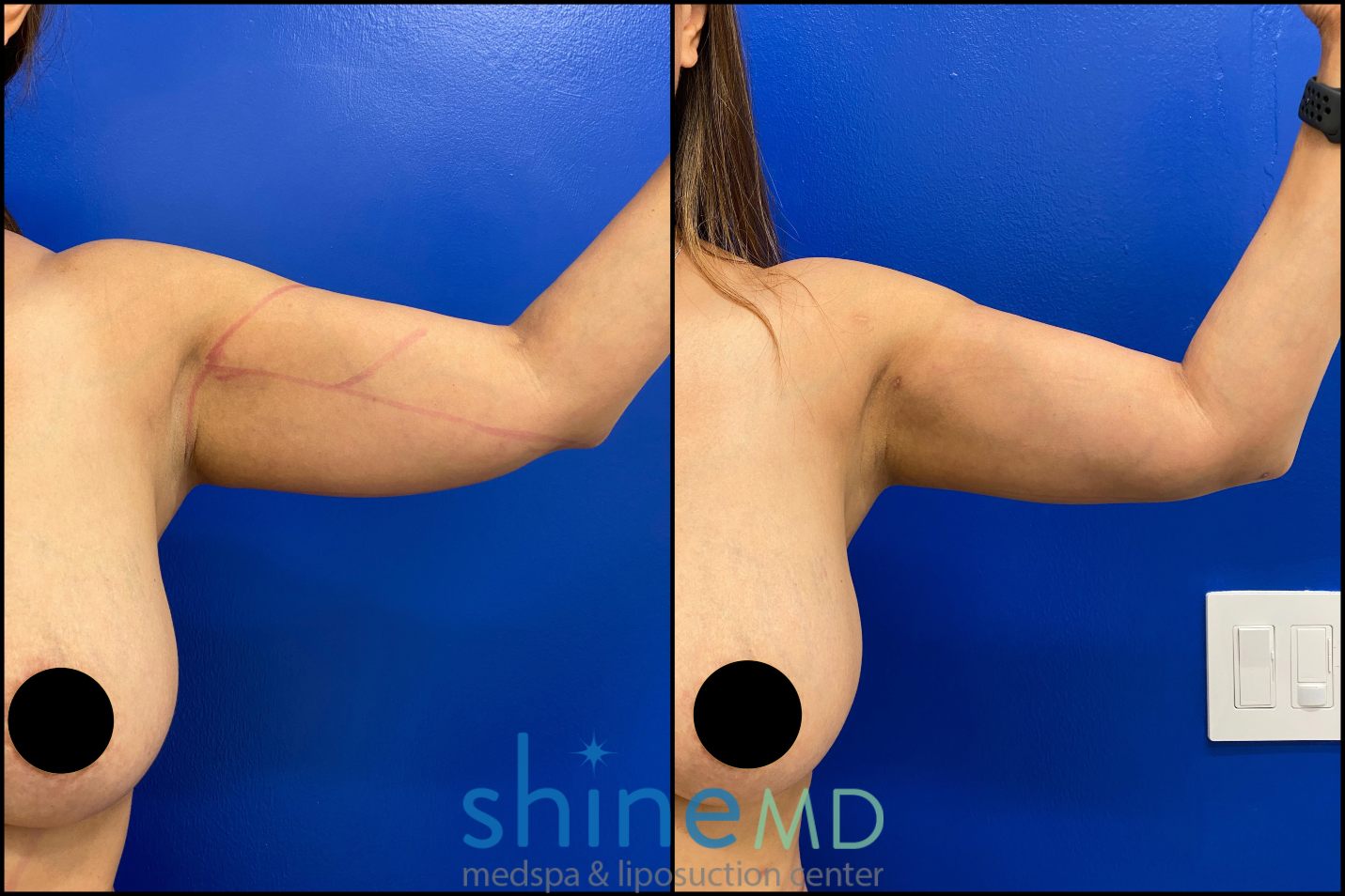 Arm Liposuction Recovery