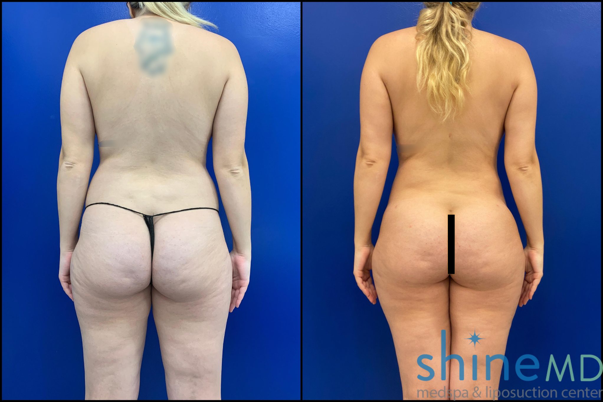 hd liposuction before and after 2