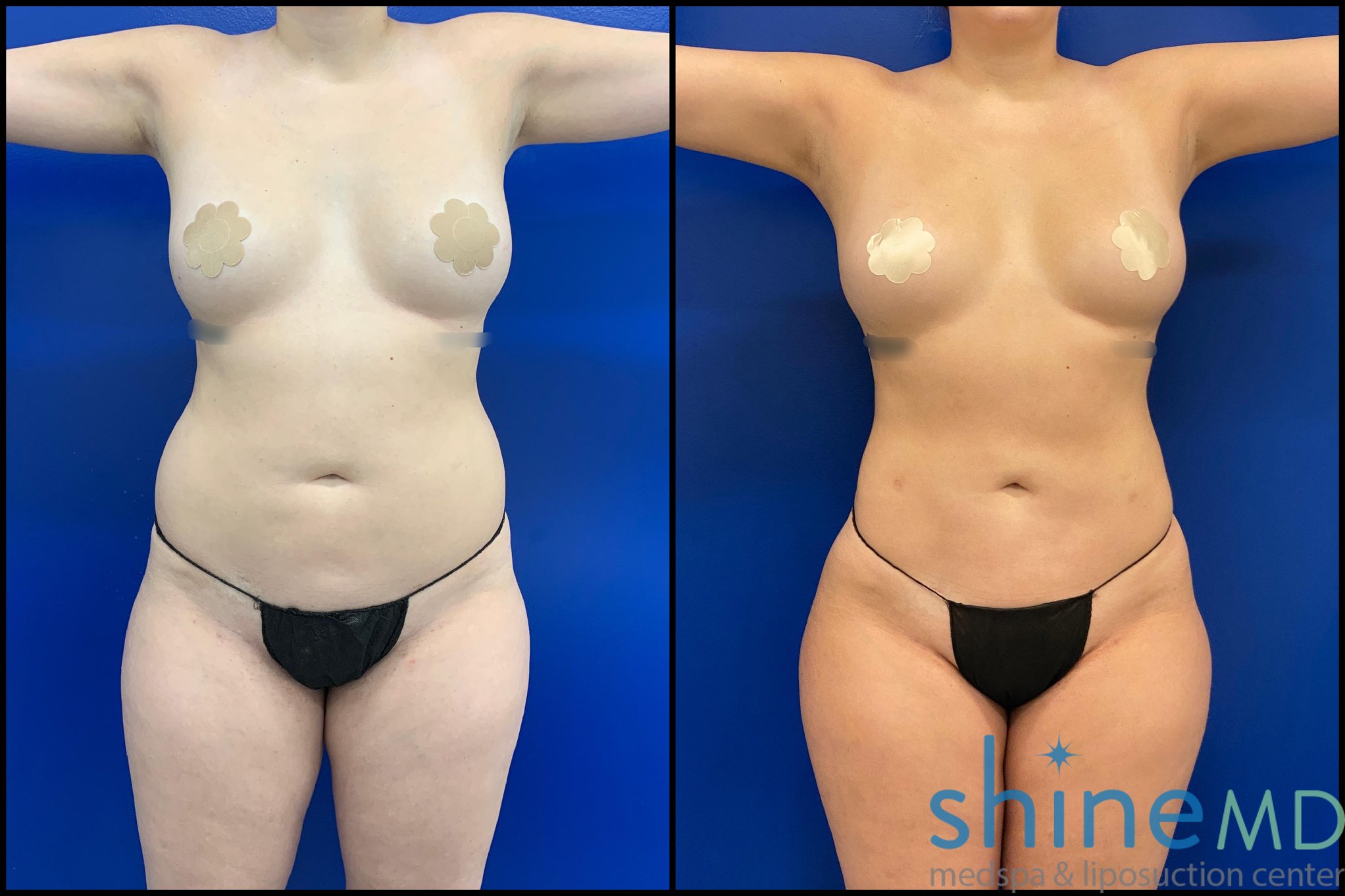 hd liposuction before and after 1