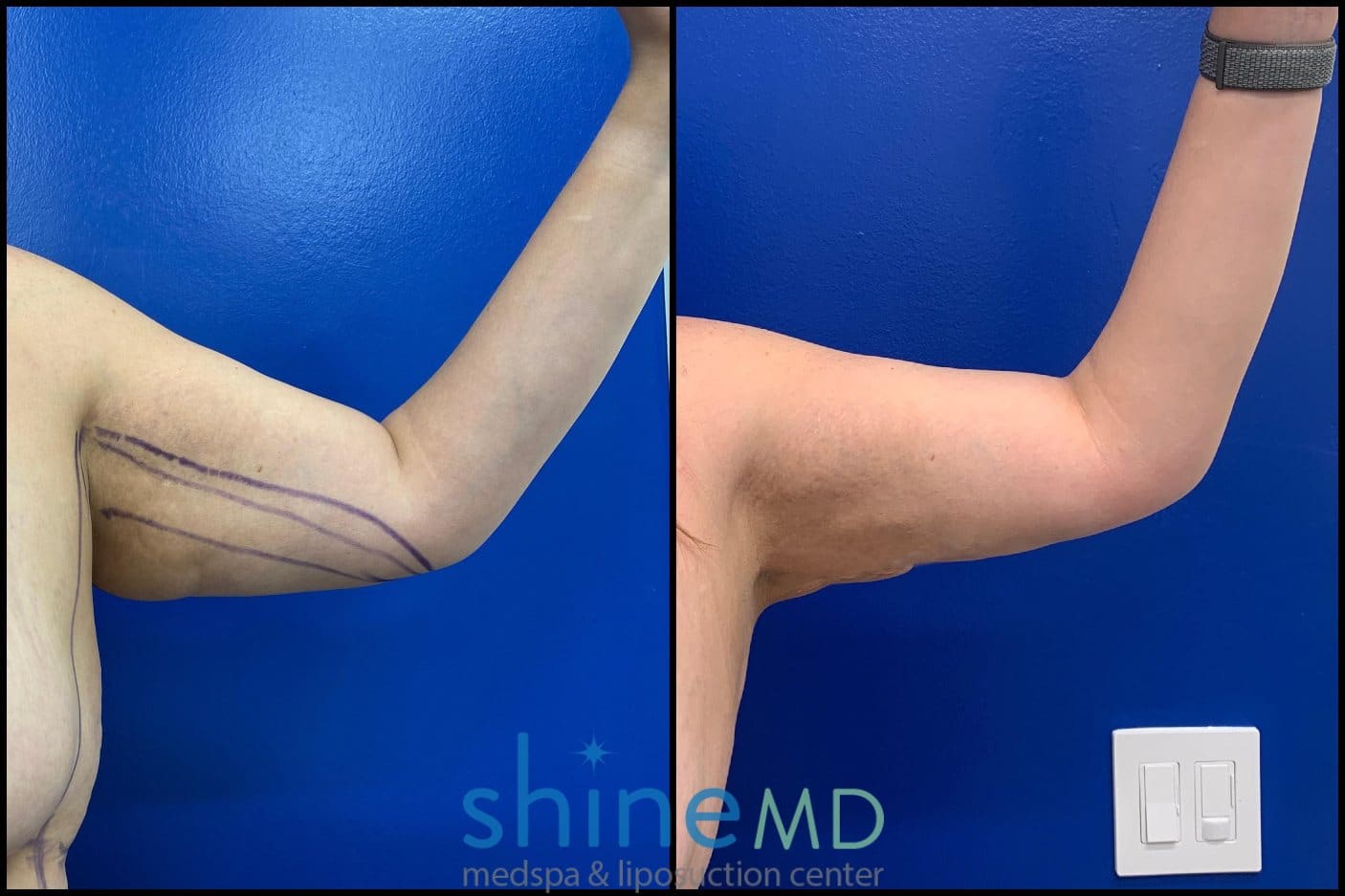 arm liposuction surgery before and after photos