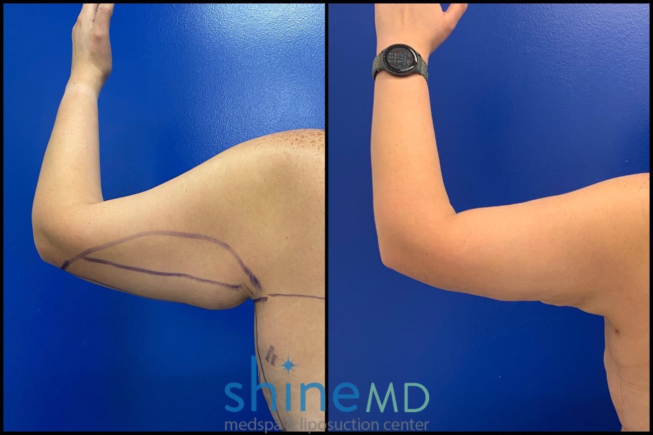 before after arm liposuction surgery results