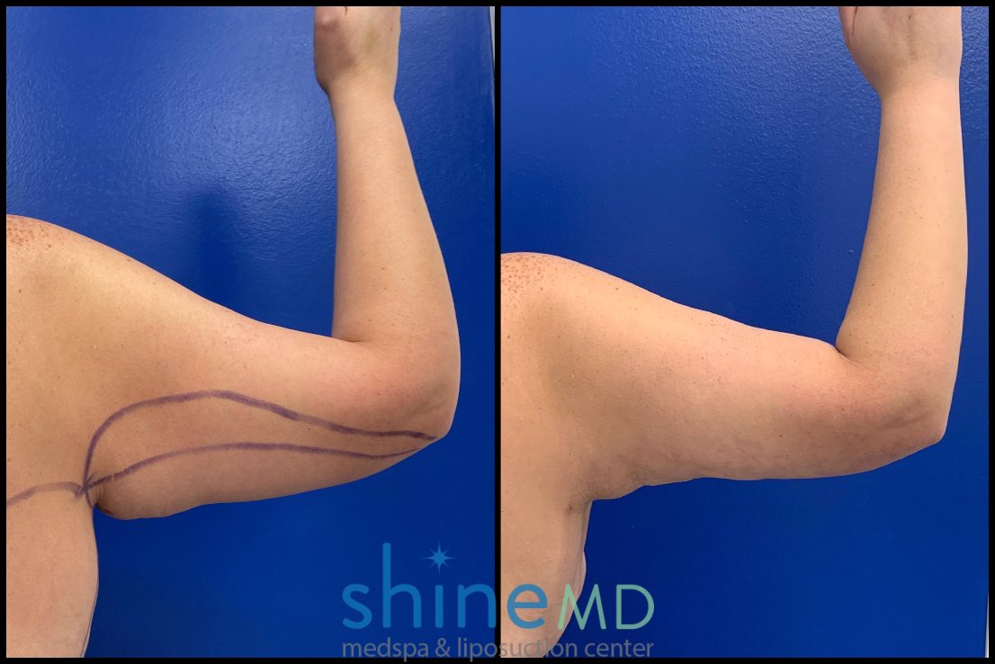 arm liposuction surgery results of our happy patients